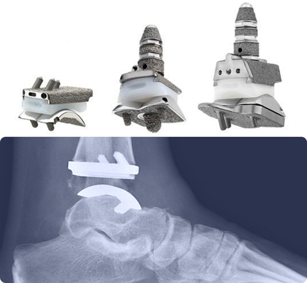 prótese de tornozelo